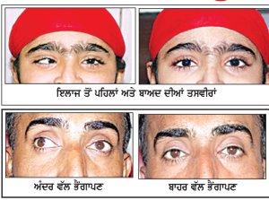 ਅੱਖਾਂ ਦਾ ਭੈਂਗਾਪਣ : ਸਮੇਂ ਸਿਰ ਪਛਾਣ ਅਤੇ ਇਲਾਜ ਜ਼ਰੂਰੀ
